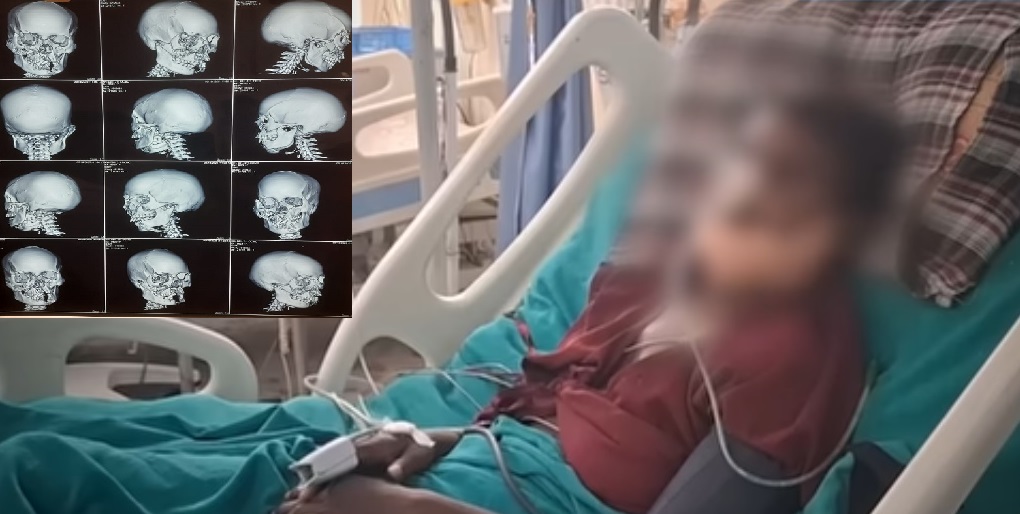 आग्लोले हानेर श्रीमानले भाँचिदिए अनुहारका सबै हड्डी, कोसी अस्पतालमा छट्पटाई रहेकी छिन् दिलकुमारी